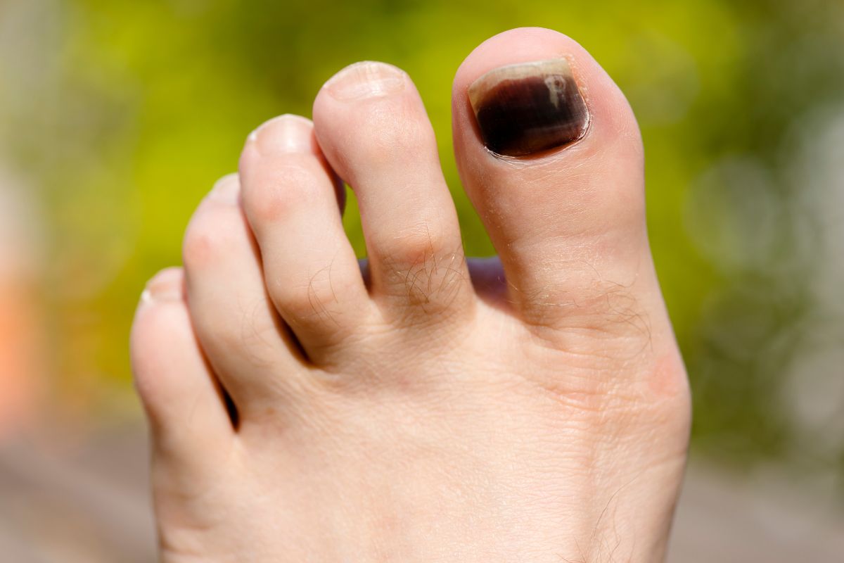 How To Deal With A Toenail Blister From Running?
