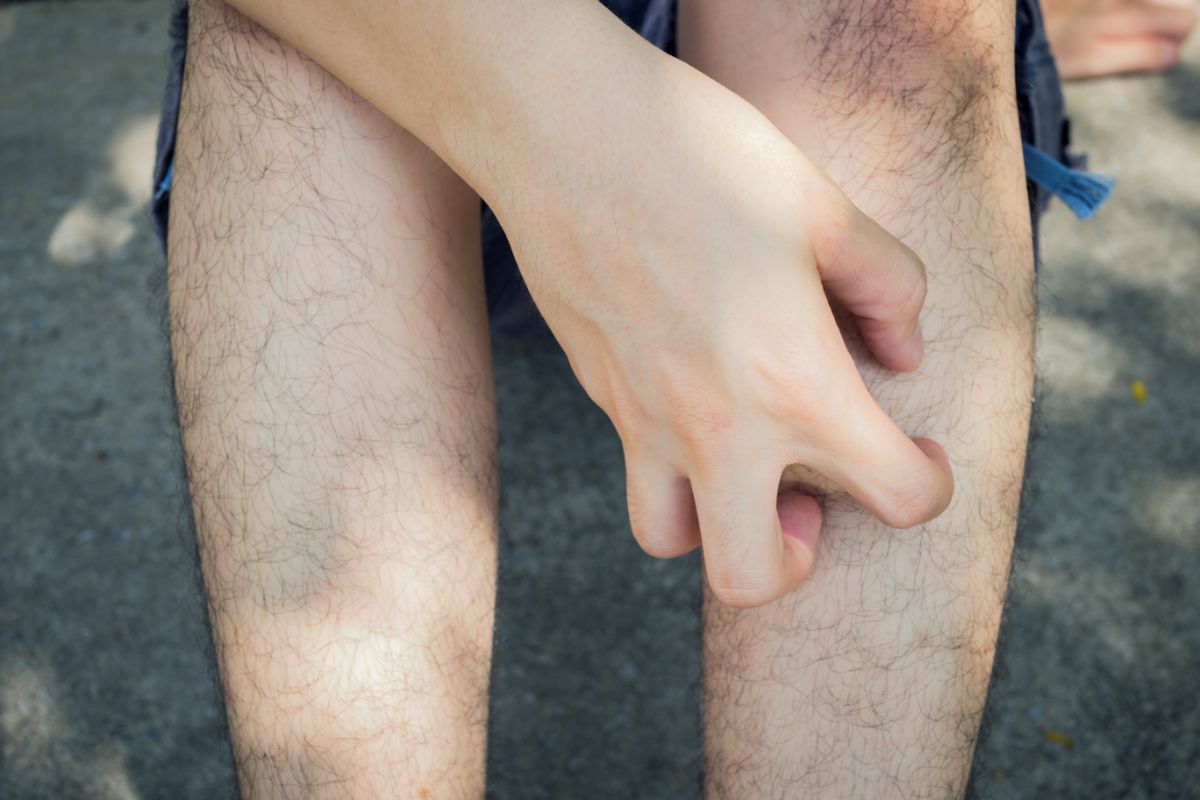 Other Solutions To Prevent Runner’s Itch